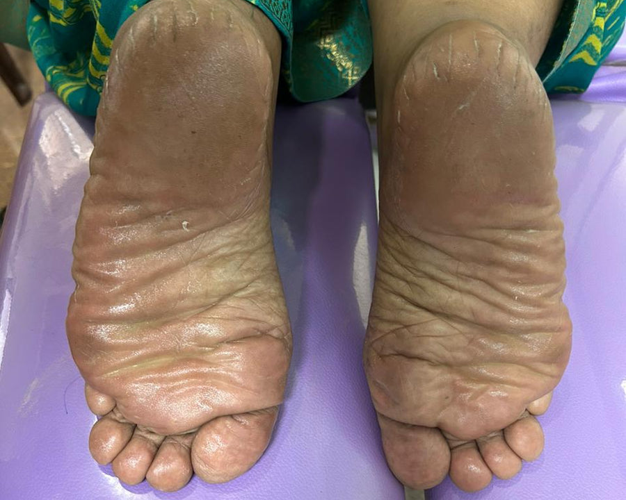 Before Treatment